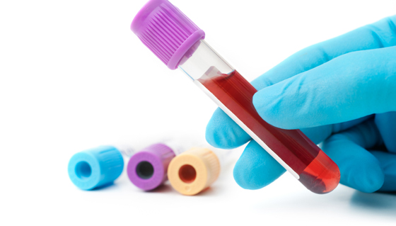 Blood Testing for TB infection