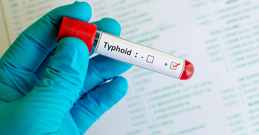 The difference between typhoid and typhus sometimes requires laboratory testing