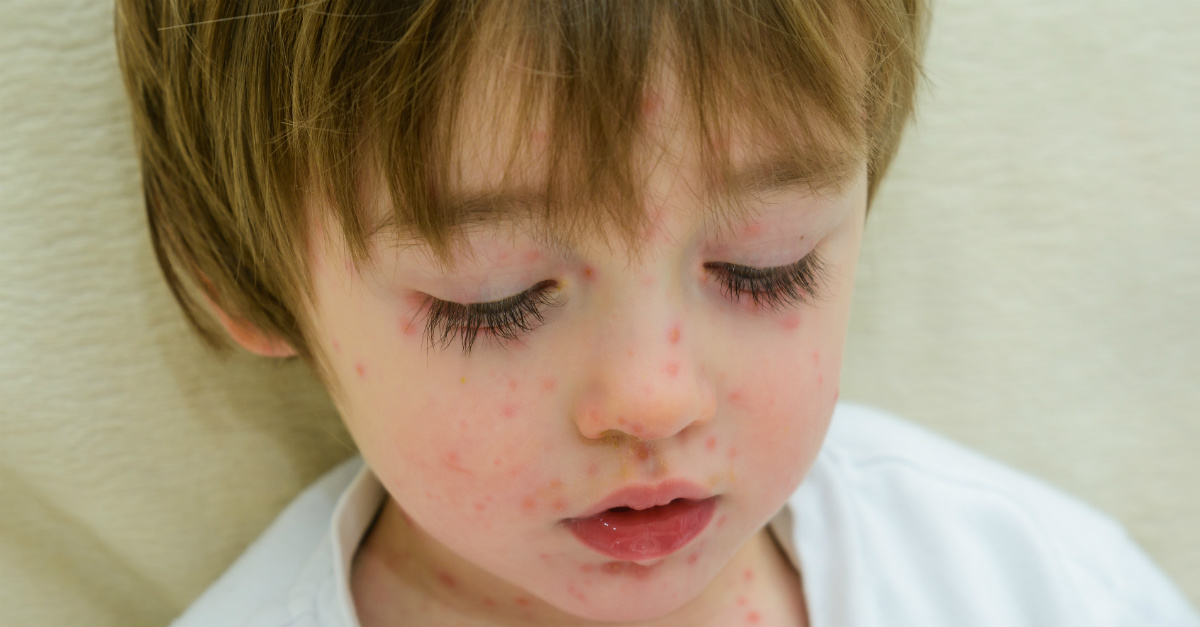 Used frequently in the past, chickenpox parties are outdated by modern standards.
