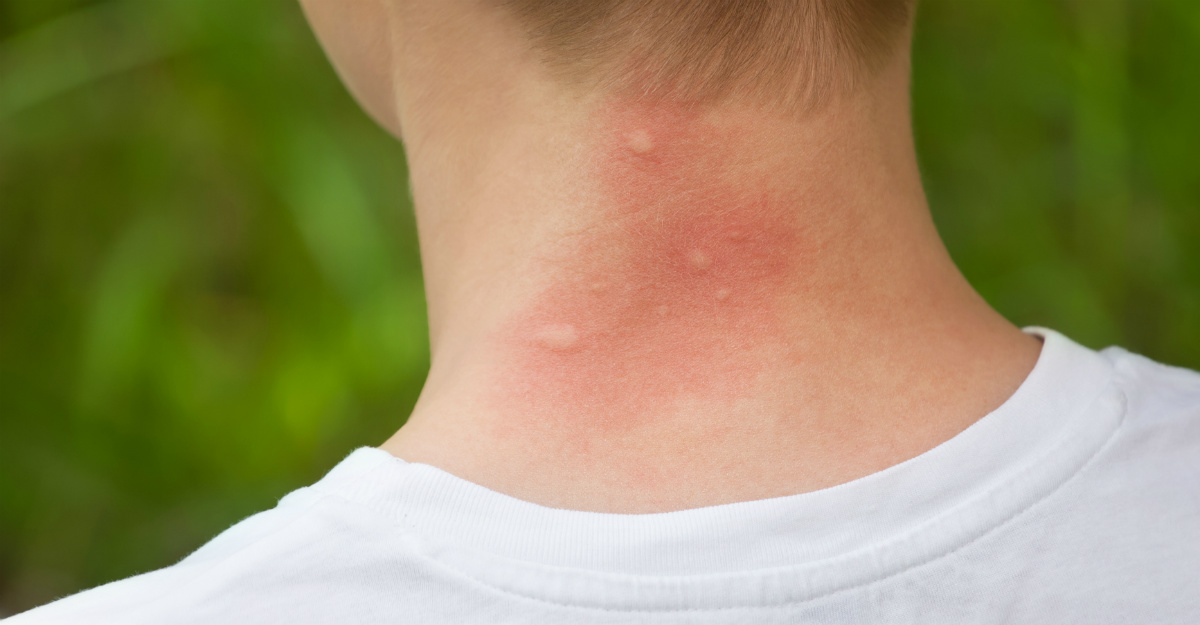 Just by looking, it can be difficult to tell if a mosquito bite proves dangerous.