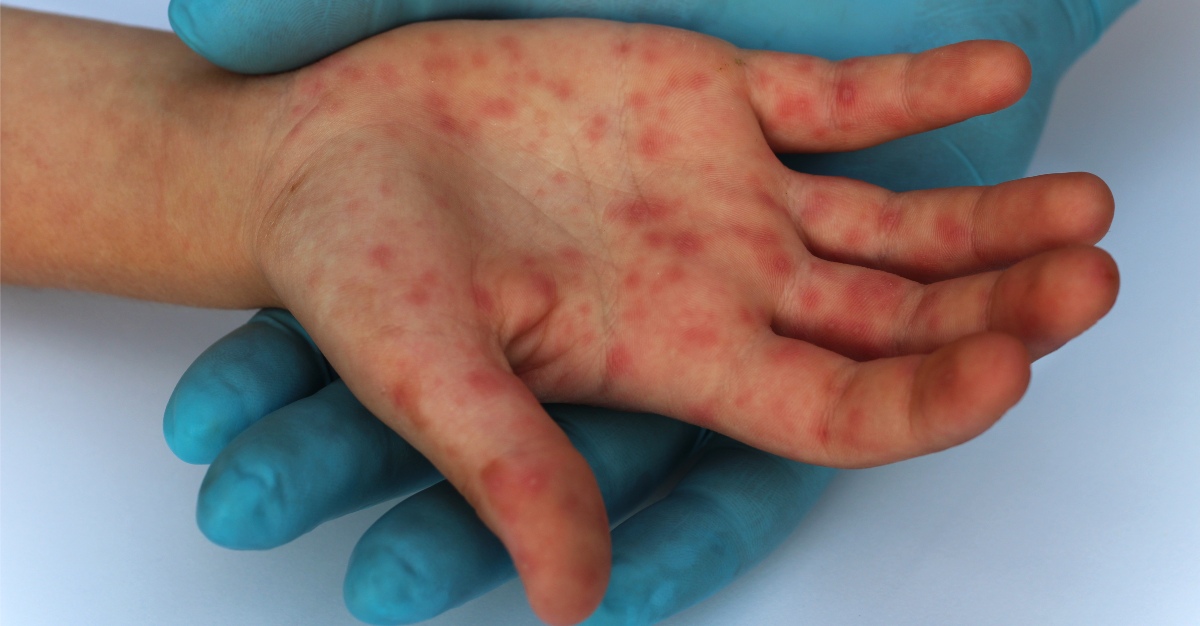Measles traces to a time before many countries had been settled.