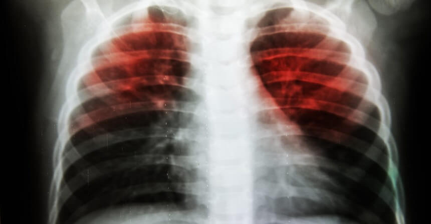 About 20 percent of the world's population could be at risk of latent tuberculosis.