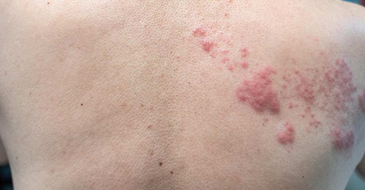One long term symptom of shingles may include nerve damage.