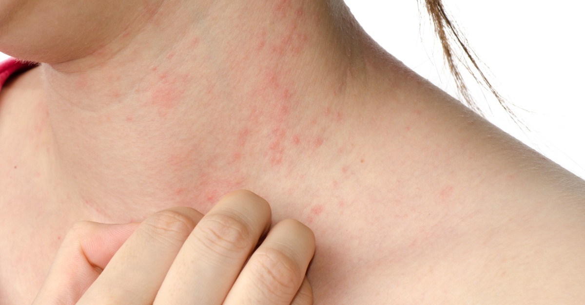 hpv vaccine side effects rash