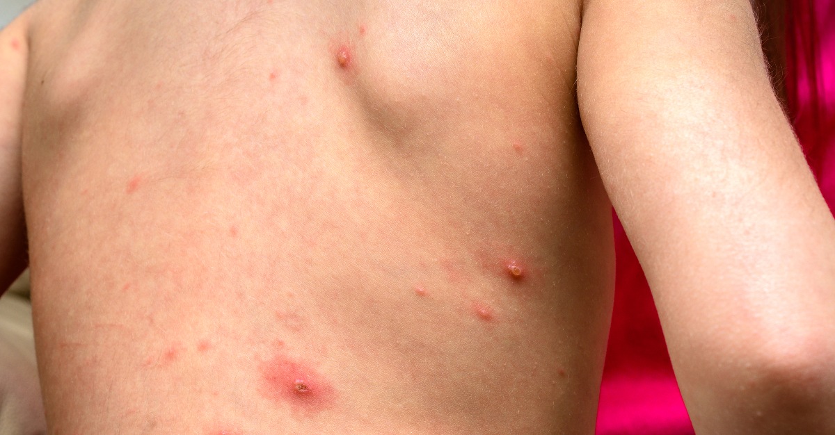 Measles has been confirmed in over half the states across the U.S.