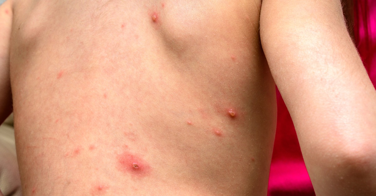 After the first case over 250 years ago, measles still has a presence in the United States.