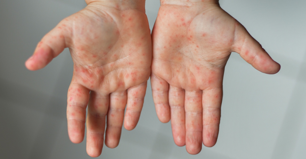 A rash is one of the clearest signs of measles infection.