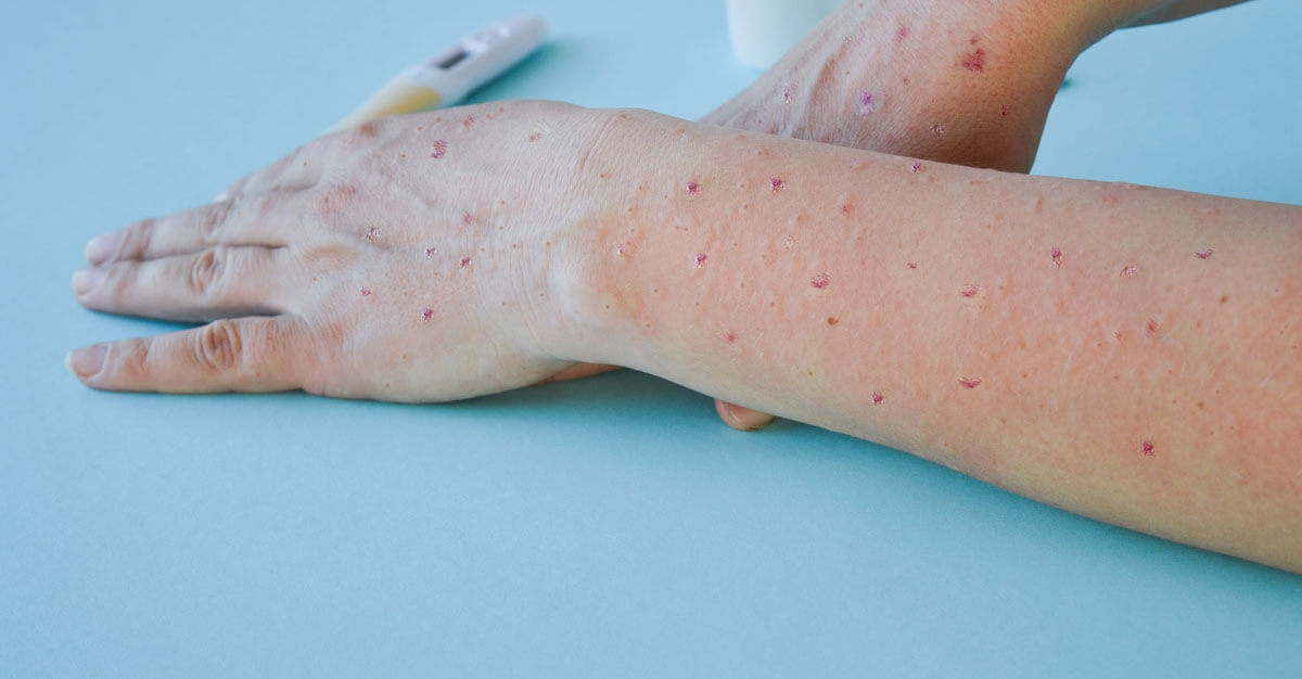 Chickenpox may be less lethal than smallpox, but it is still a risk.
