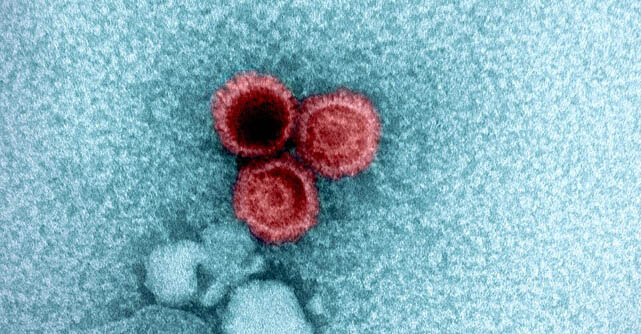 Researchers found strong evidence linking Epstein-Barr virus infection to multiple sclerosis.