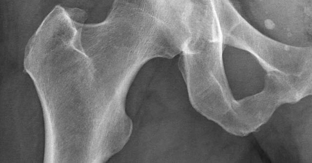 X-ray image of the hip joint
